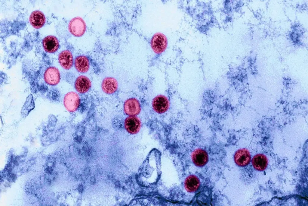 Genetic Vulnerabilities to Epstein-Barr Virus Uncovered by Large-Scale Study
