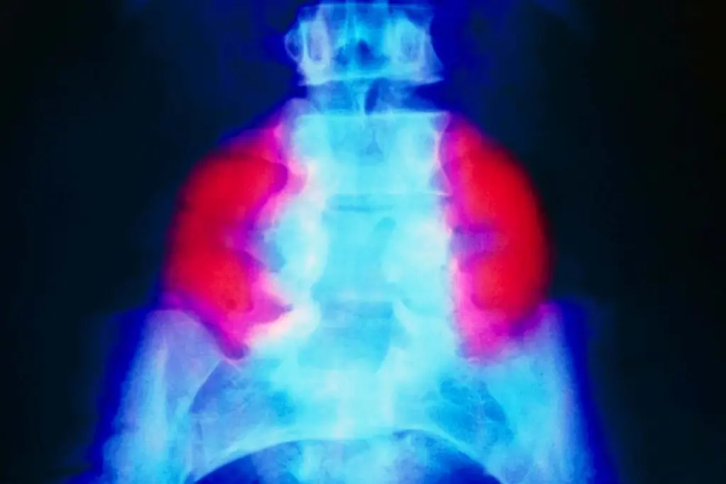 World-First Trial Uses Placental Stem Cells to Treat Severe Spina Bifida In Utero
